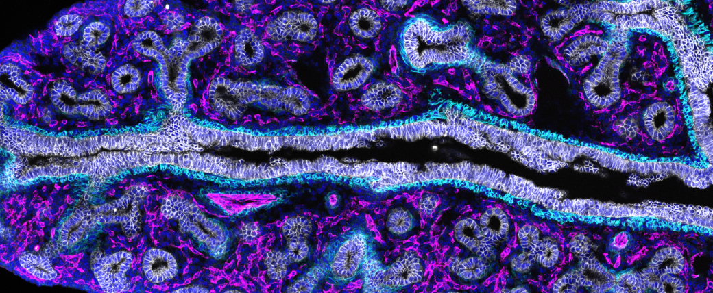 Slice of lung in purple, with white-lined holes and a crevasse down the middle