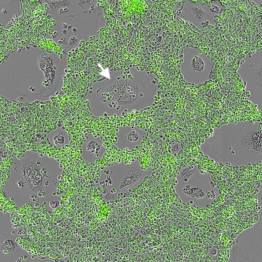 Macrophages, one labelled with a white arrow, within a surrounding of green long cancer cells